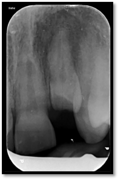 Dental trauma management - Pre-operative photo and X-ray case 3